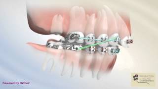 Class II Correction with Second Molar Extraction