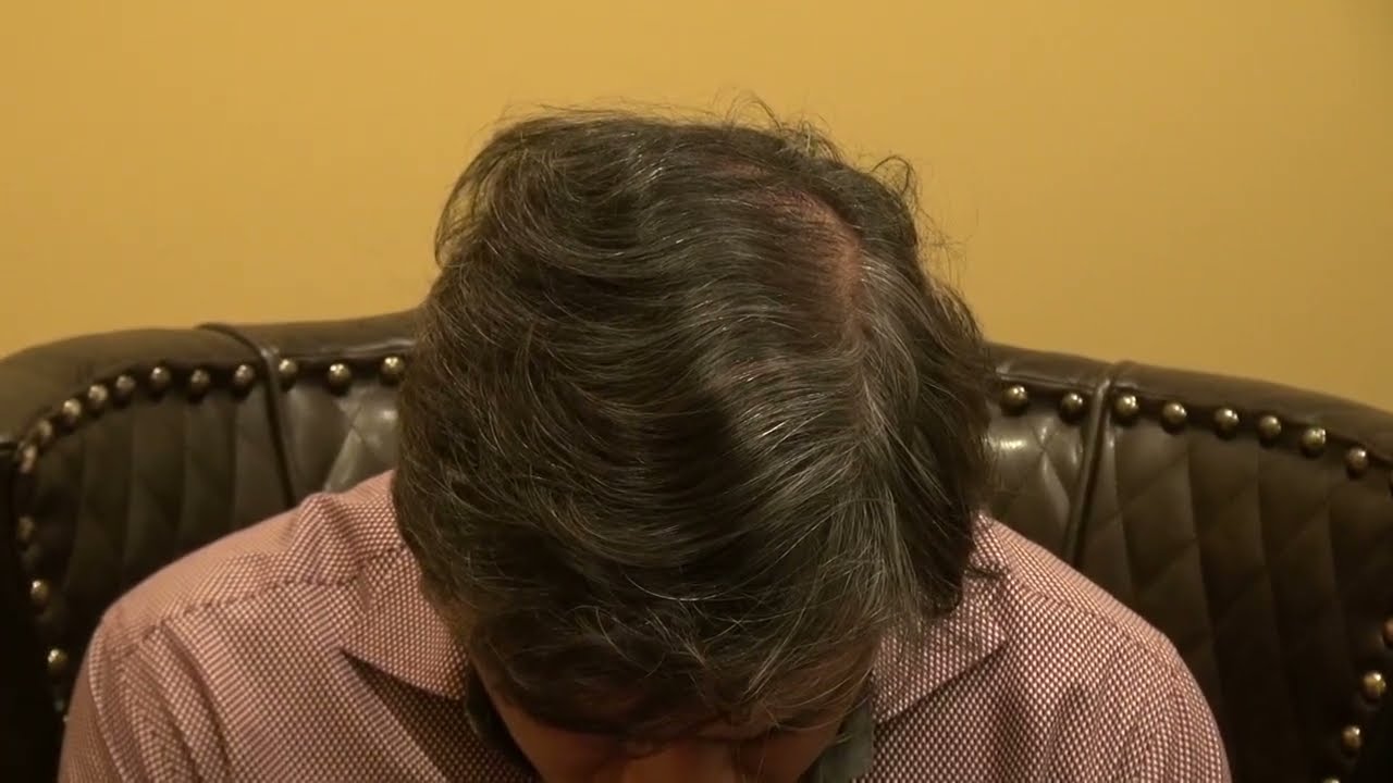 Crown Vertex Hair Transplant | 1-Year Results & Transformation
