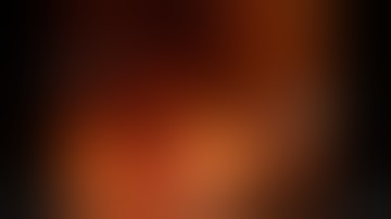 robotic prostatectomy by Dr Geoff Coughlin 2017 unedited, narrated