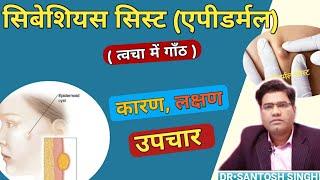 What is SEBACEOUSCYST? its Cause Symptoms and Treatment |  (Epidermoid) Cyst Explained