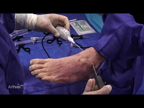 NanoScope™ Camera for Foot and Ankle Arthroscopy