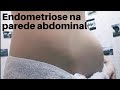 ENDOMETRIOSE DA PAREDE ABDOMINAL É GRAVE?