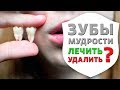 Зуб мудрости - вся правда! Зачем нам нужны зубы мудрости | Дентал ТВ