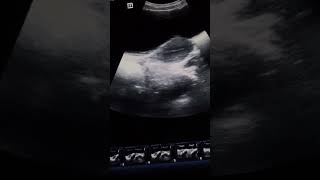 subserosal fibroid #viralvideo #ultrasound #shortvideo #ultrasound unic fact video