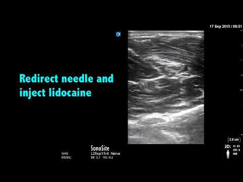 ipack nerve block cpt code ipack nerve block cpt code