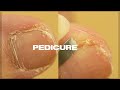 Satisfying PEDICURE TRANSFORMATION at home | Cuticle &amp; Callus Removal