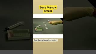 Bone Marrow Smear Preparation