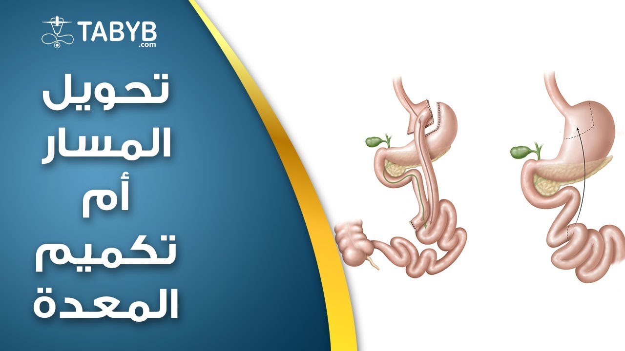 تحويل المسار ام تكميم المعدة دكتور أسامة فؤاد