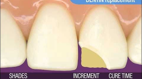 3M ESPE ● Anterior Restorations — Simple Technique
