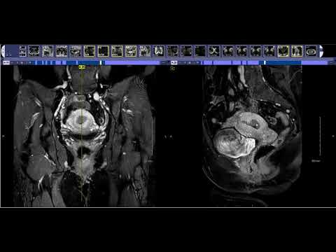 Video: MRI Kanser Endometrium - Bagaimana Kita Melakukannya