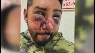 ABC10 Exclusive; Stockton man talks allegedly being beaten by San Joaquin County officers