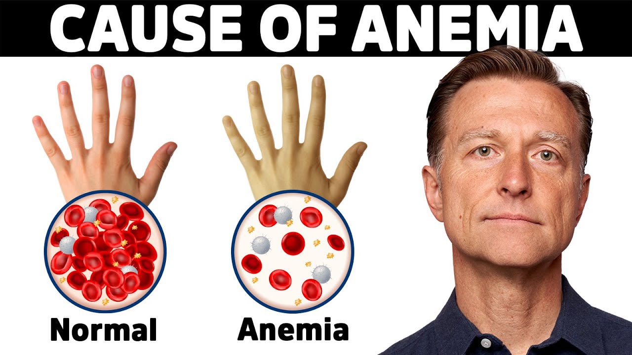 ⁣The Hidden Cause of Anemia You've Never Heard About