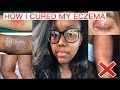 HOW I CURED MY ECZEMA FOREVER!