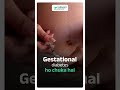 Attention moms to be! #gestationaldiabetes #maternalhealth #pregnancycare #doctor #bloodsugar