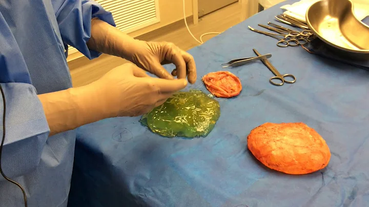 En Bloc Breast Implant Removal of Ruptured Implant