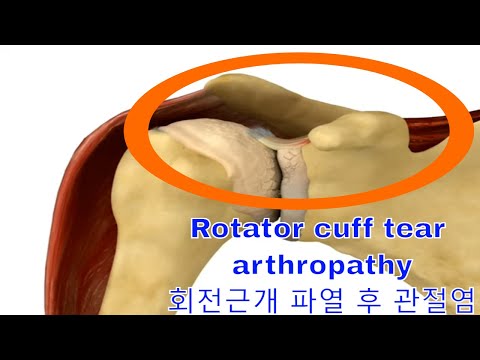Rotator cuff tear arthropathy