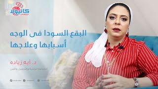 البقع السوداء في الوجه - الأسباب والعلاج | مع د. أيه زياده | أميره كل يوم