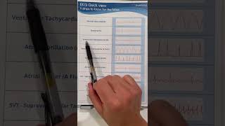 ECG strips memory tricks