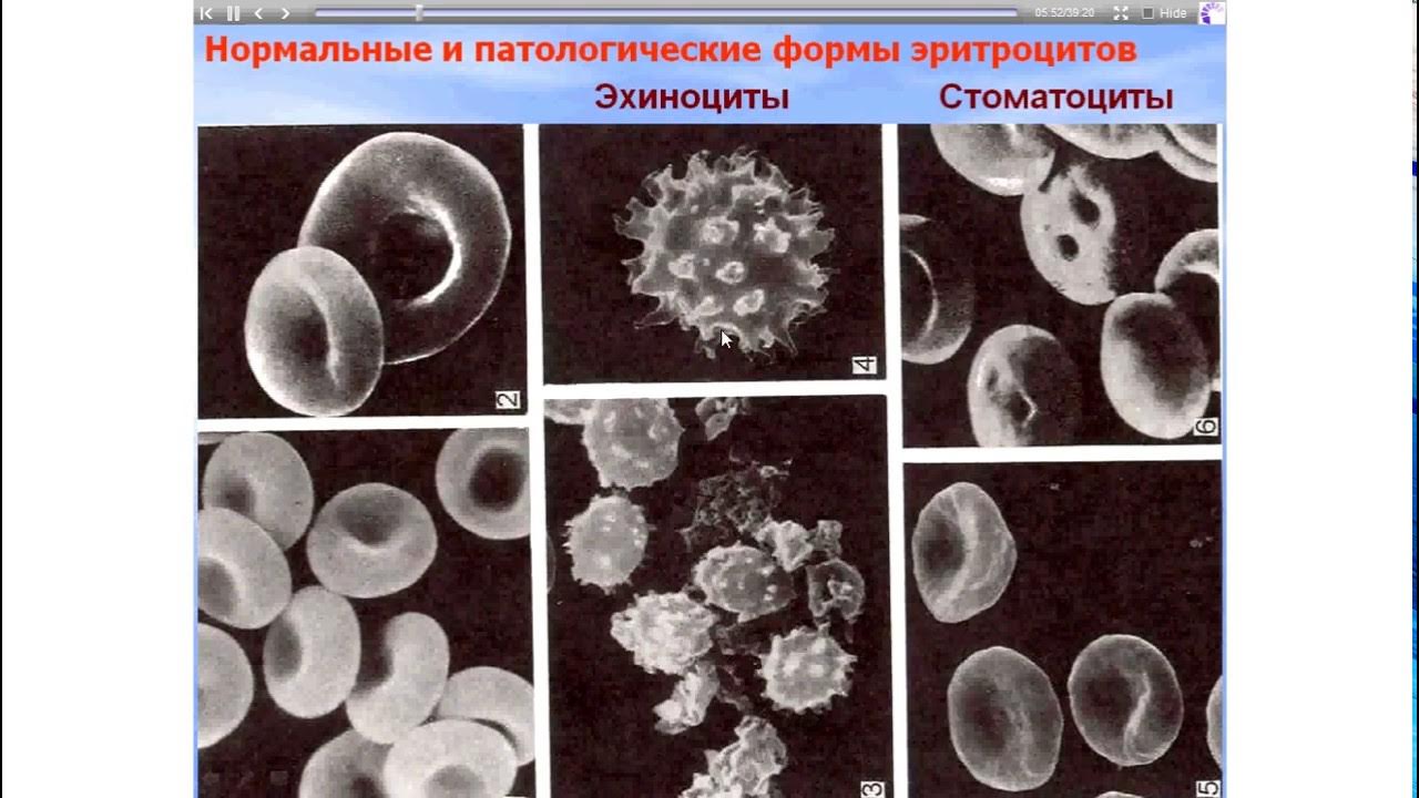 Эритроциты различной формы. Эритроциты электронограмма. эхиноциты эритроциты. формы эритроцитов эхиноциты. эритроциты различной формы в сканирующем электронном микроскопе.