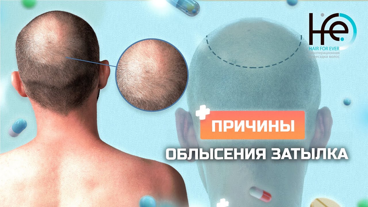 Лысеет затылок? Почему так происходит? - YouTube