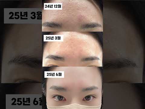 뷰트리 멜라 솔루션 화이트정