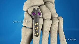 TriMed ASET™ Foot Plating System Overview
