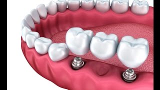 Multiple Teeth Implants