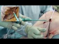 ALL (Anterolateral Ligament) Reconstruction