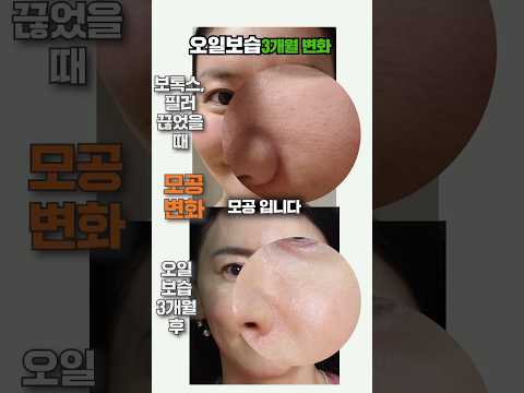 오일로 보습한지 3 개월 후