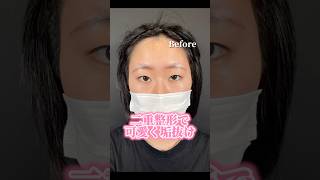 【目元整形】二重整形で可愛く垢抜け#shorts
