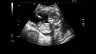 Extra - Uterine Pregnancy Or Ectopic Pregnancy. This Is A Case Of Abdominal Pregnancy.