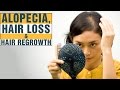 7 Best Home Remedies For ALOPECIA AREATA, Rapid Hair Loss & Baldness