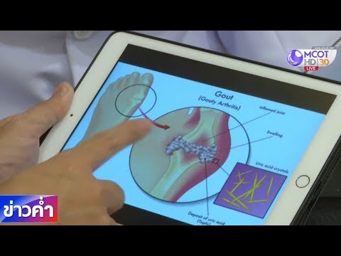 ชัวร์ก่อนแชร์ : วิวัฒนาการของโรคเกาต์ จริงหรือ?