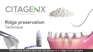 Ridge Preservation Bone Graft Technique Using Dental Products | Citagenix
