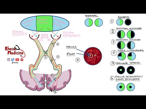 Visual Field Defects and Optic Nerve Pathway |  Homonymous Hemianopia Bitemporal Hemianopia NEW 2020