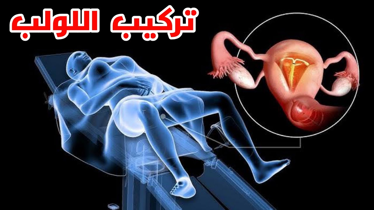 شاهد كيف يتم تركيب اللولب لمنع الحمل عند المرأة_IUD insertion animation