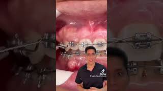ortodoncia correctiva ligaduras metálicas #dental #dentalbraces #dentist #dentalcare #ortodoncia