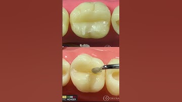 Lm arte replica posterior of 6