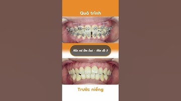 Hành trình LỘT XÁC nhờ niềng răng của Huyền Trang