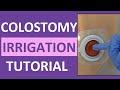 Colostomy Irrigation Procedure Care | Ostomy Enema Nursing | Stoma Cleaning