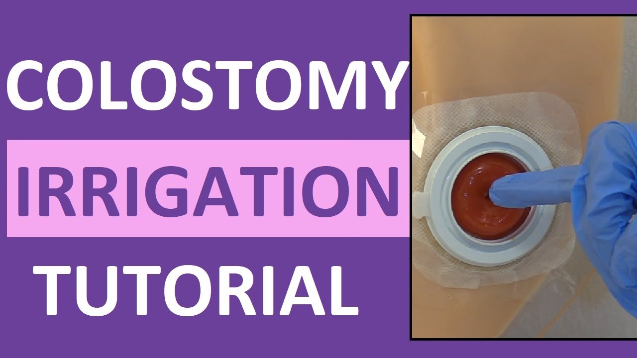 Colostomy Irrigation Procedure Care | Ostomy Enema Nursing | Stoma Cleaning