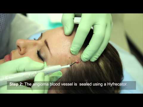 How to remove an angioma using curettage and cautery