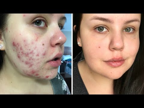  PRODUCTS THAT TRANSFORMED MY SKIN | Acne Scarring
