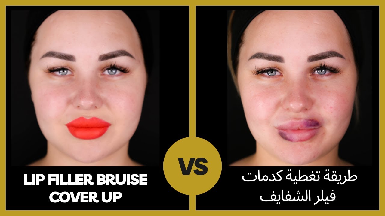 lip-filler-bruise-coverage-youtube