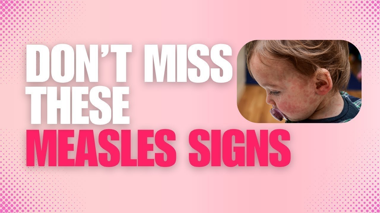 Measles in Kids: 3 Signs Parents Must Know!