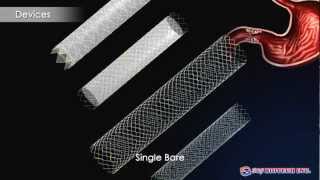 S&G Biotech-EGIS Pyloric Stent