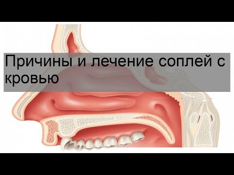 Причины и лечение соплей с кровью