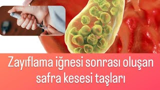 Zayıflama iğnesi safra kesesinde taş yaparsa ne yapmalı? - Prof Dr Ahmet Karabulut