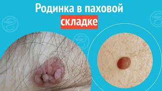 ▶️ Родинка В Паховой Складке. Клинический Случай №1400