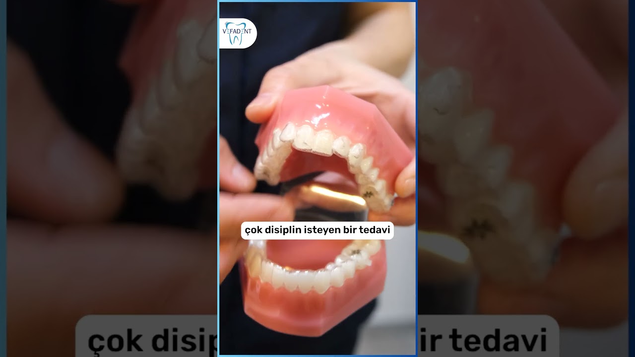 Diş teli mi daha iyi şeffaf plak mı?